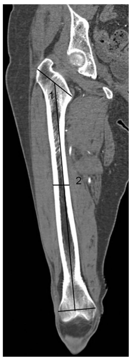 Fig. 1. CT scan of the right lower limb in the coronal plane: measurements of femoral diaphysis length (1) and width (2). 