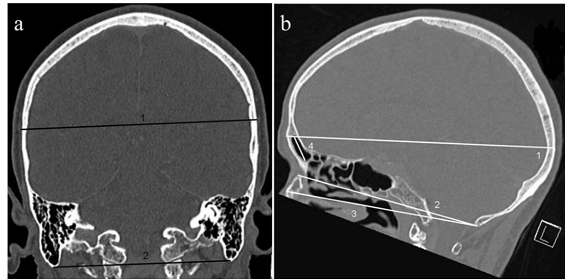 Fig. 2. (A) CT scan of the skull in the coronal plane: measurement of maximum cranial width (1) and distance between the mastoid processes (2); (B) CT scan of the skull in the sagittal plane: Measurement of maximum cranial length (1), length of cranial base (2), distance from the posterior extremity of the cranial base to the nasal bone (3) and frontal sinus height (4). 