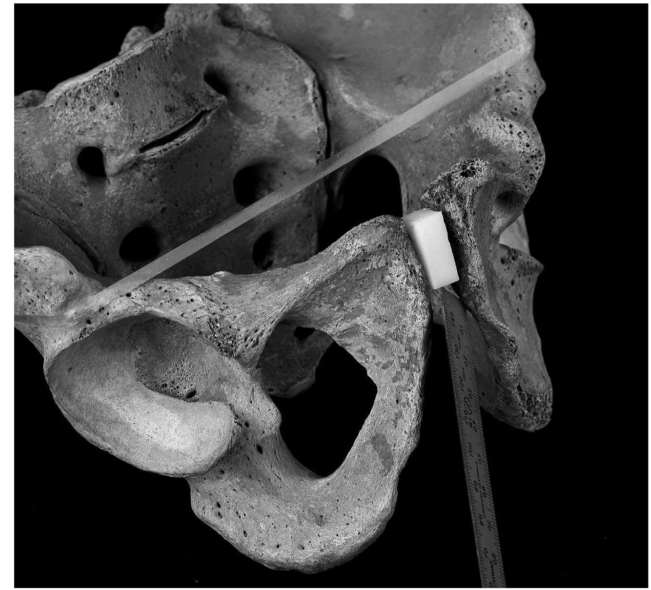 Fig. 9. Illustration for the insertion of thin sharp instrument in the reconstructed pelvis. A steel scale with a breadth of 10mm was placed its long side on the extension of the long axis of the cut mark and its flat surface on the smooth face of the cut mark. 