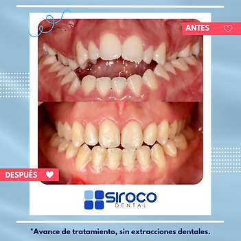 Antes y después de Invisalign