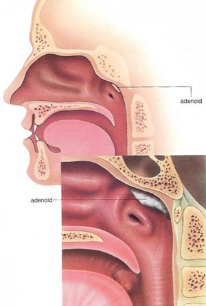 ___location of adenoid