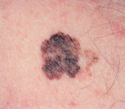 melanoma