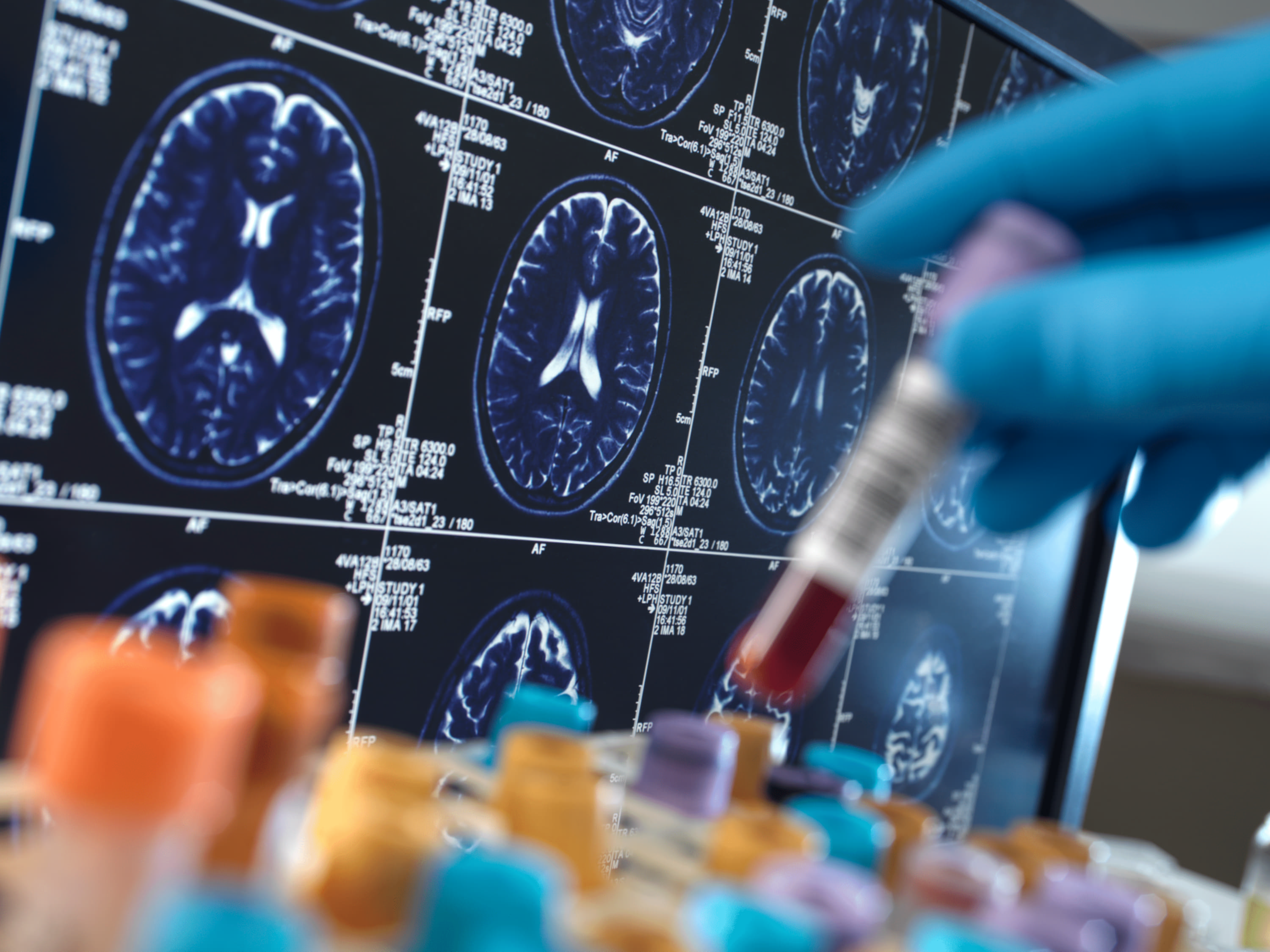 Dementia Tests